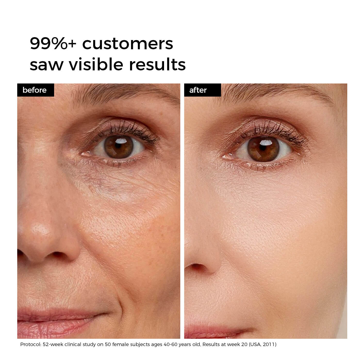 Before and after comparison of a woman's eye area with visible skin improvement.