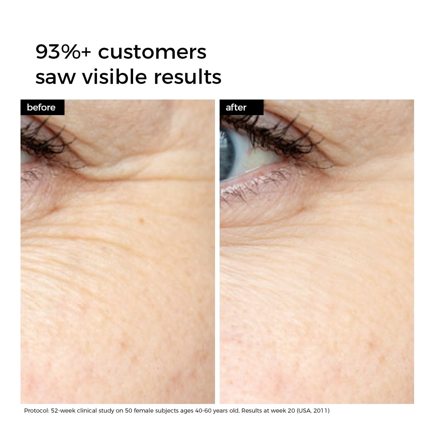 Before and after comparison of eye area with visible skin improvement.