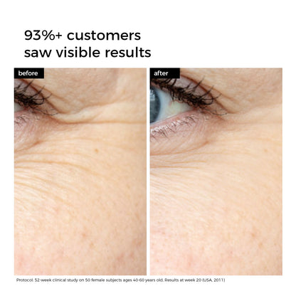 Before and after comparison of eye area with visible skin improvement.